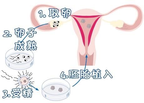 供卵试管选性别代生公司生殖中心